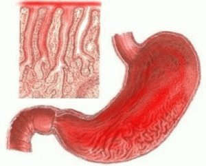 Exacerbatie van gastritis