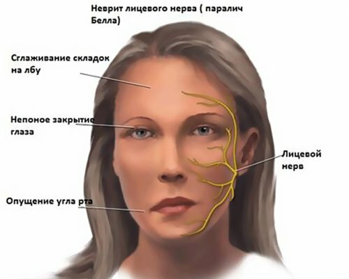 Symptomen van ontsteking van de gezichtszenuw en behandelingen