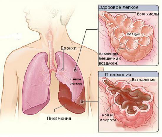 segmentær lungebetændelse