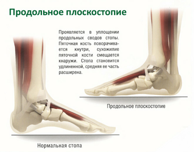 Features of longitudinal flat feet