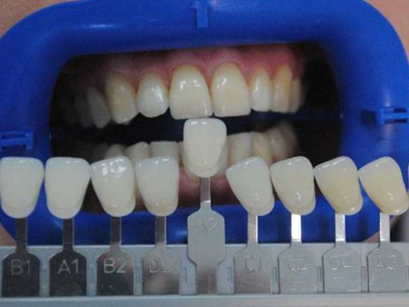 Цвета зубных протезов по шкале фото