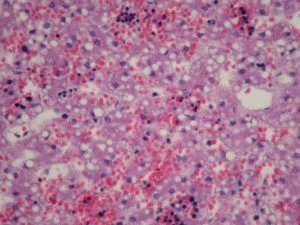Patologia de esteatose hepática aguda