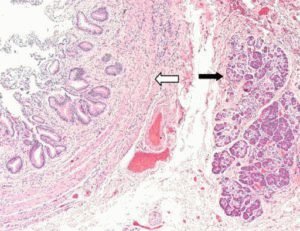 Complicaties van chronische pancreatitis en de gevolgen ervan