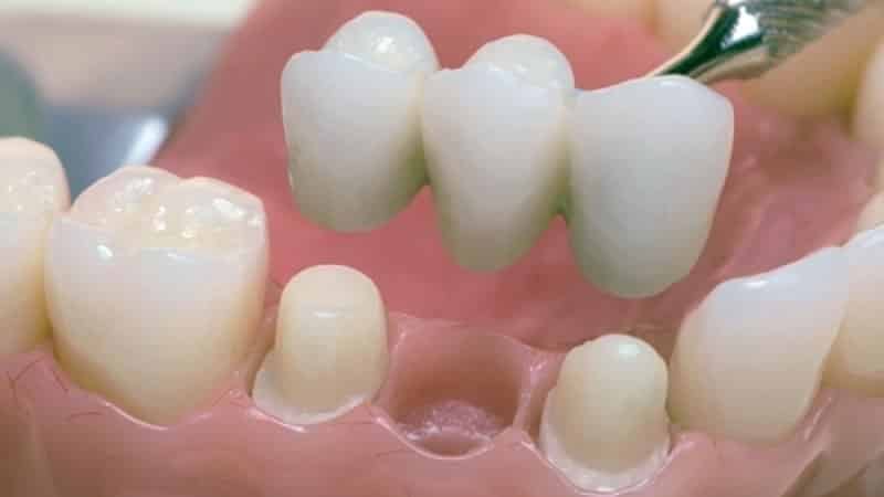 Plastic proteesid: plusse ja miinuseid, kulud