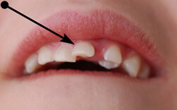 Dislocation of a tooth