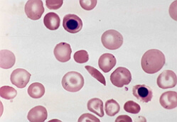 B12-pomanjkanje anemije