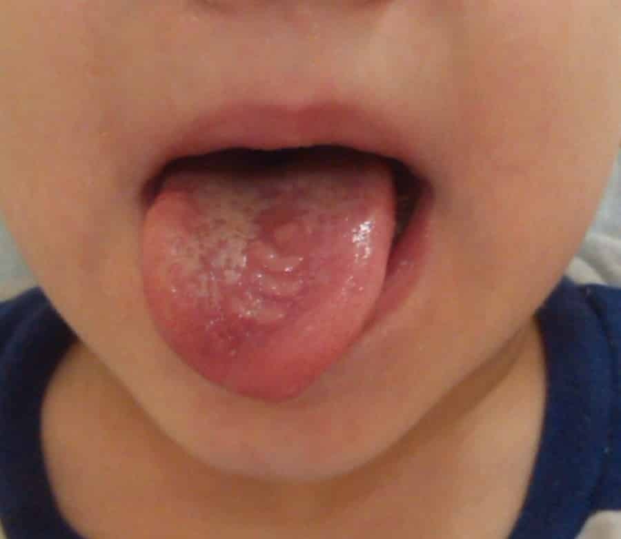 Macchie rosse sulla lingua negli adulti: cause, le foto