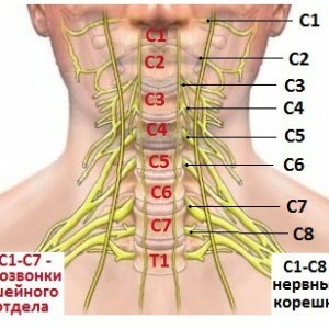 una hernia de disco-en-cuello de base-nervio-300x300