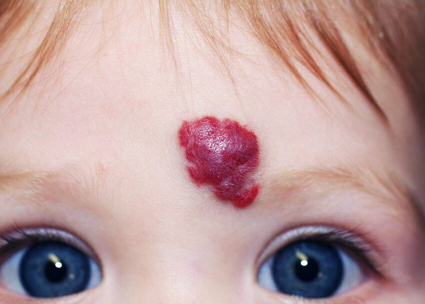 ¿Cómo tratar el hemangioma de la piel en adultos y niños?