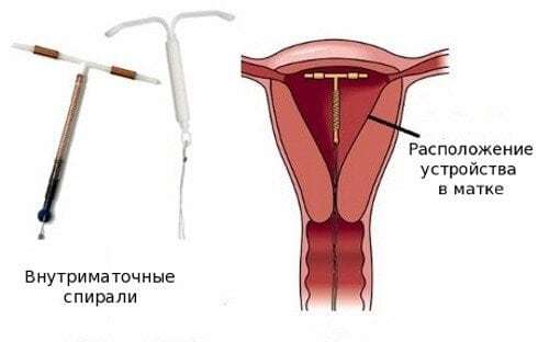 Spiralna Mirena s endometriozom, što je to