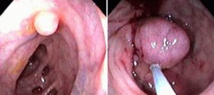 adenomateuze poliep