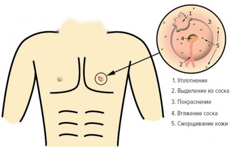 Pathologies of mammary glands in men - enlargement, compaction, cancer