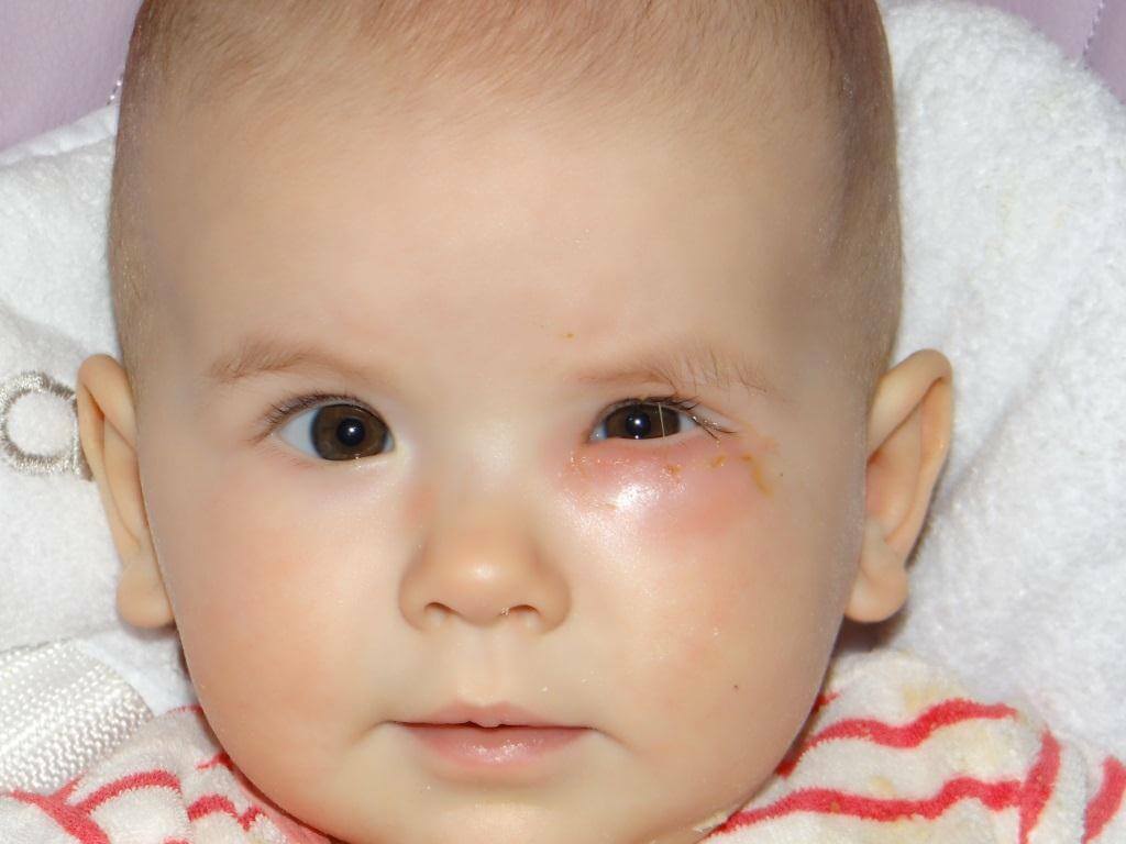 Obstruktion der Tränenkanal bei Neugeborenen: Symptome und Behandlung