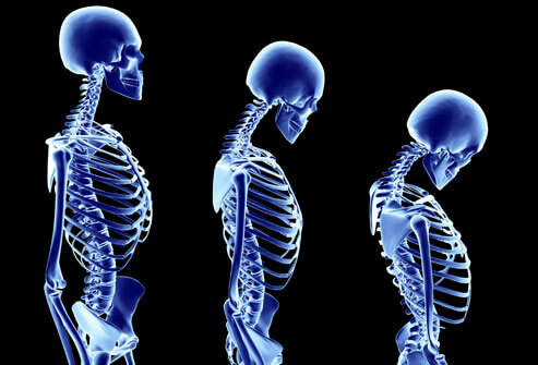 Osteoporosis - tratamiento, prevención