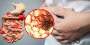 Crohnova choroba