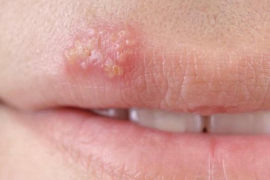 L'herpès sur les lèvres est transmis par un baiser?