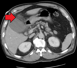 Cholecystitis betegség