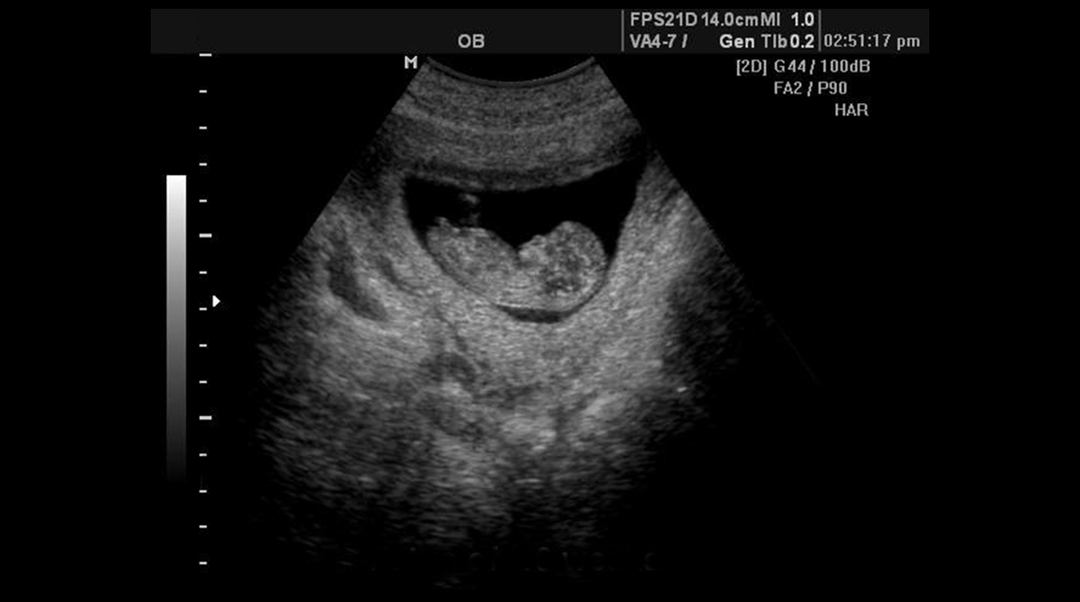 Ultrasound vóór 10 weken