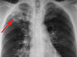 Tuberkuloza fotografije pluća