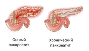 A pancreatitis betegsége