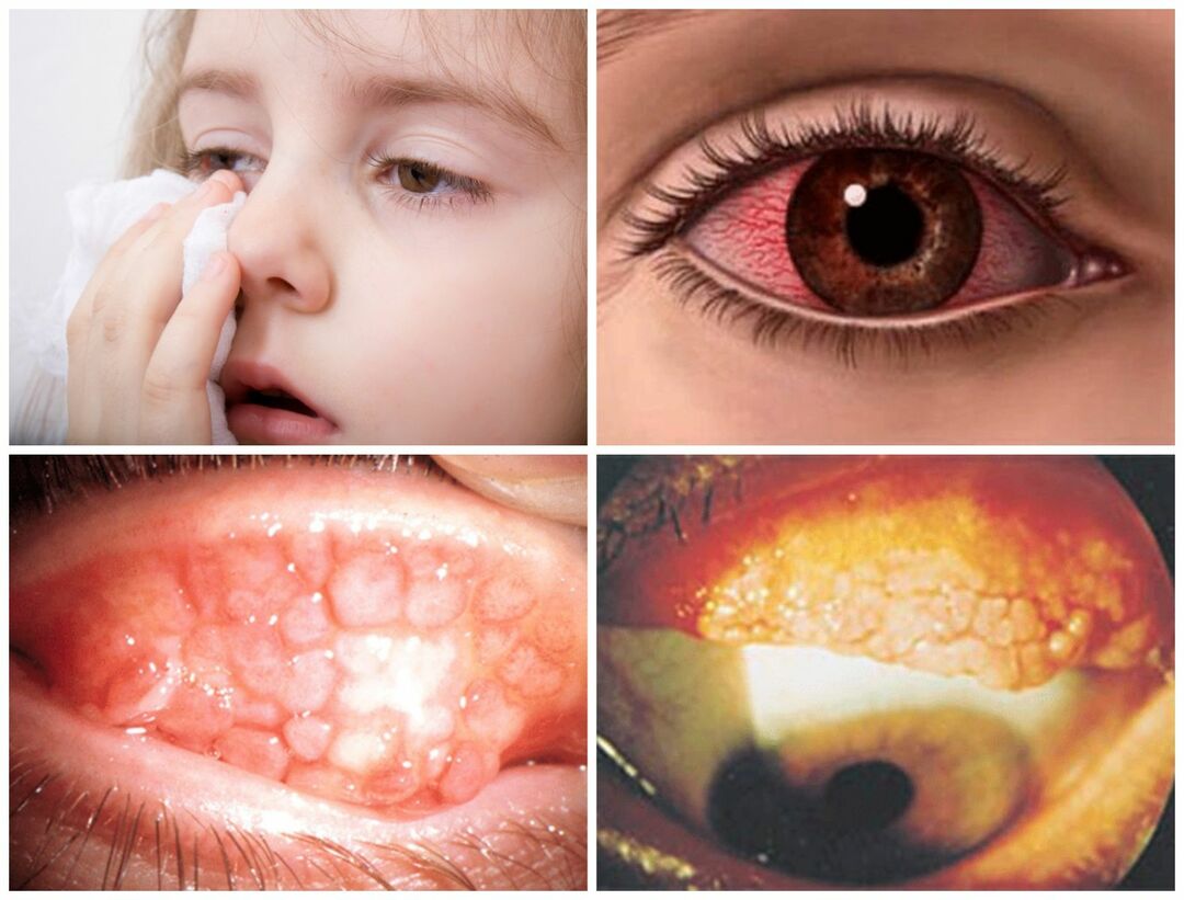 A conjuntivite alérgica: sintomas e tratamento