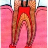 Methoden van endodontische behandeling