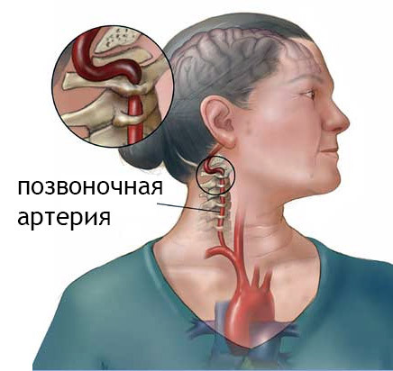 syndrom vertebrální tepny