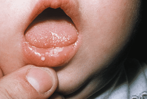bagaimana memperlakukan luka dingin di mulut gambar pengobatan gejala anak