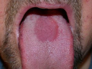 Simptomi eritroplastije usta