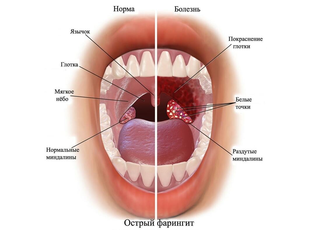 Symptoms of pharyngitis