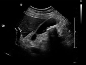 Cardiologische cholecystitis