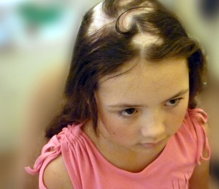 Alopecia areata hos barn