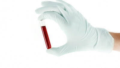 Der Test zur Bestimmung der Menge an Immunglobulin E