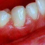 Methods for eliminating bleeding gums