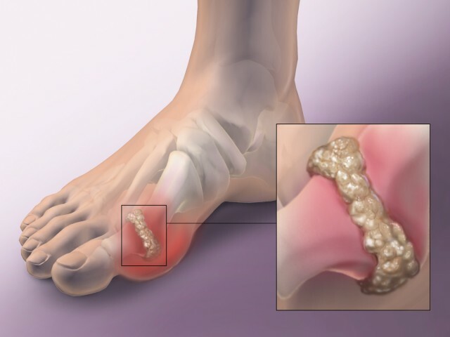 Gout: signs and treatment