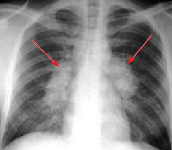 Plaučių sarkoidozė