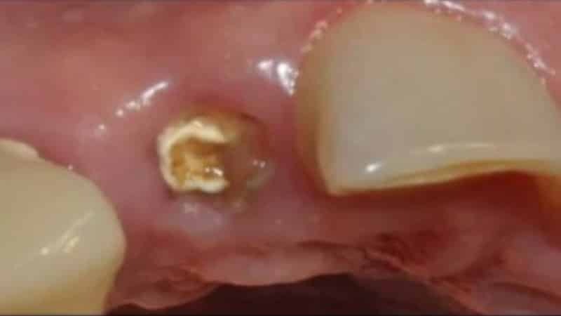 Witte vlekken op het tandvlees na het trekken van tanden: wat het is