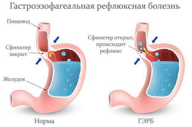 La maladie de reflux gastro-oesophagien