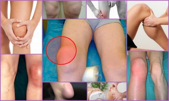Suprapatellyarny bursitis de la articulación de la rodilla
