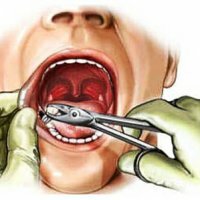 Tooth extraction: indications for removal, removal process, complications and consequences