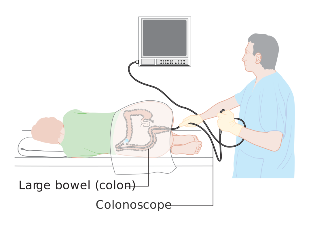 Colonoscopie van de darm: voorbereiding op de procedure