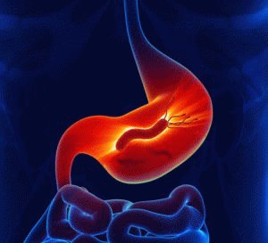 Hypertrofische gastritis: oorzaken, symptomen en behandeling