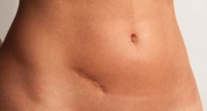 Appendicitis ar