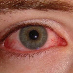 olhos alergia
