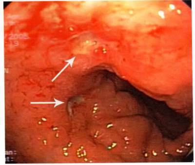 Infiltrative stomach cancer