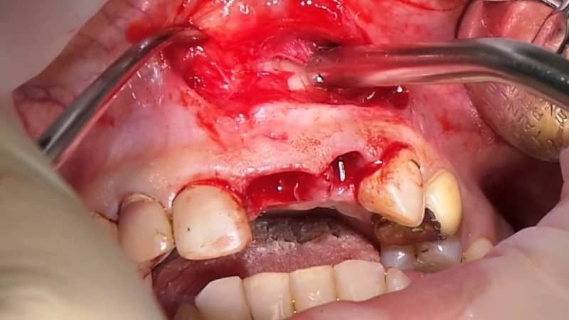 Tooth extraction with a cyst on the root