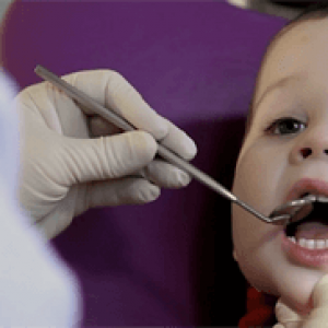Filling of baby teeth