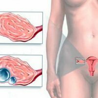 Ovarian cyst rupture
