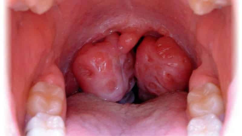 tonsilitis kronis dirawat di rumah