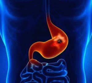 Medus skrandžio ir dvylikapirštės žarnos opoms gydyti